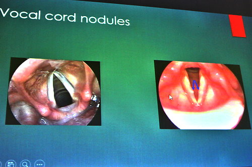 Vocal cord nodules